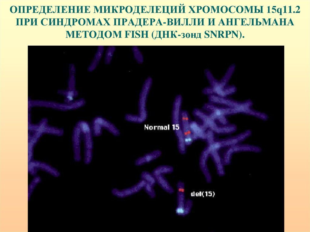 Гены 5 хромосомы. Синдром Прадера -Вилли делеция 15 хромосомы. Микроделеция хромосомы. Синдром Прадера-Вилли. Синдром Прадера Вилли и Ангельмана.