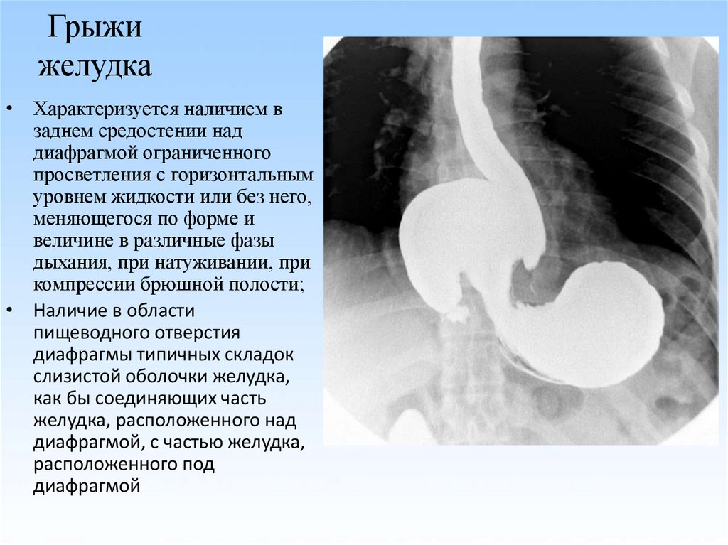 Гпод это. Параэзофагеальная грыжа желудка. Диафрагмальная эзофагеальная грыжа. Грыжа пищеварительного отверстия диафрагмы.