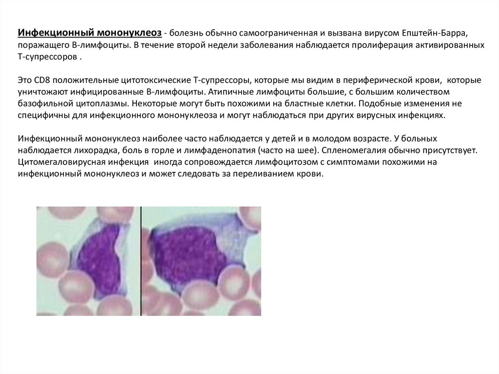 Атипичные лимфоциты. Гематологические особенности лейкозов. Атипичный лимфоцит. Атипичность раковой клетки проявляется. Воспаление с реактивными изменениями клеток