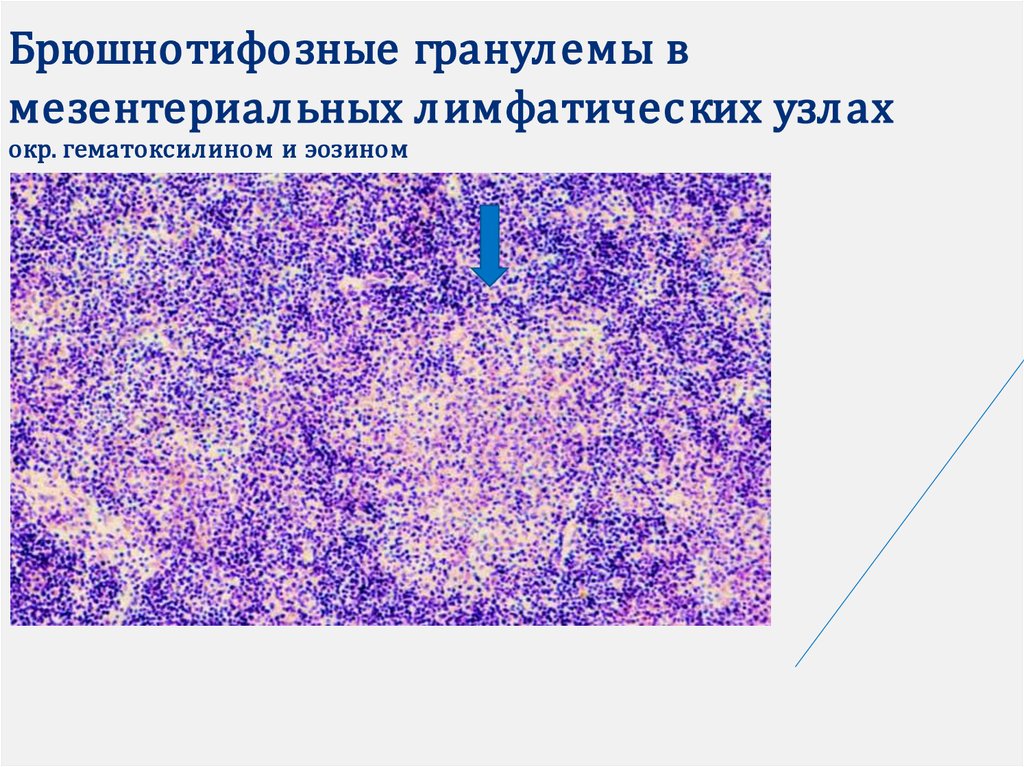 Микропрепарат лимфатический узел. Некроз лимфатического узла гистология. Брюшнотифозная гранулема. Лимфатический узел микропрепарат. Лимфатический узел при брюшном тифе.