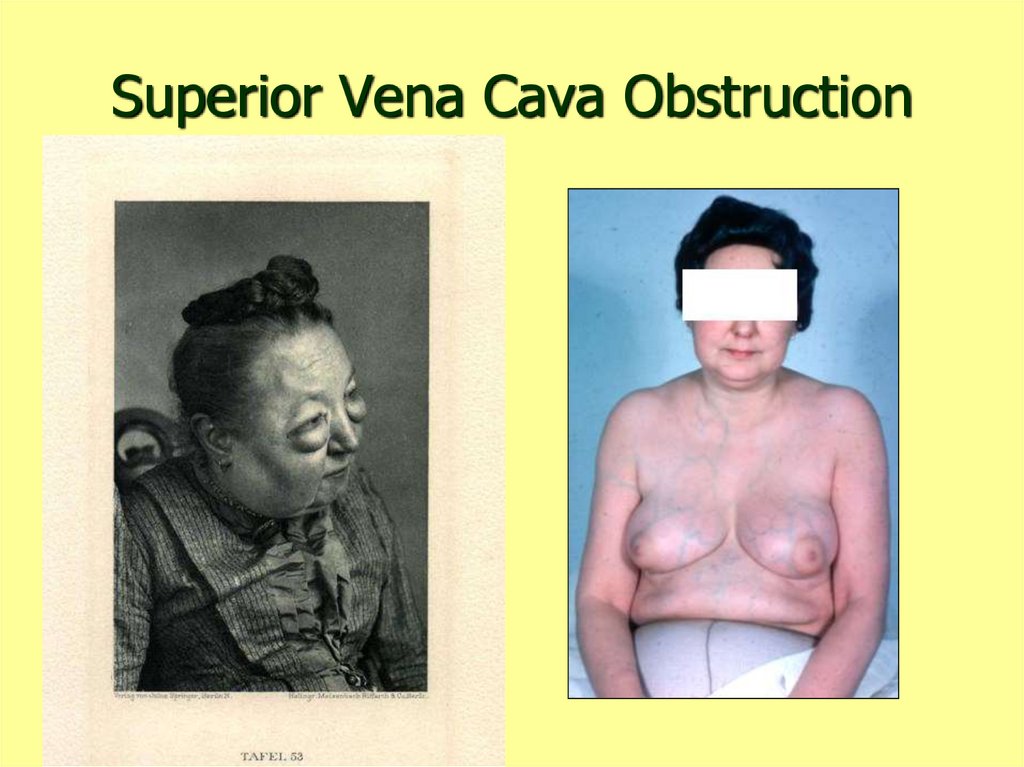 Superior Vena Cava Obstruction