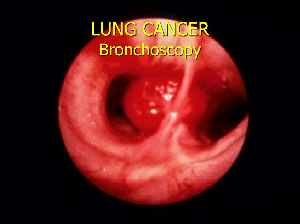 LUNG CANCER Bronchoscopy