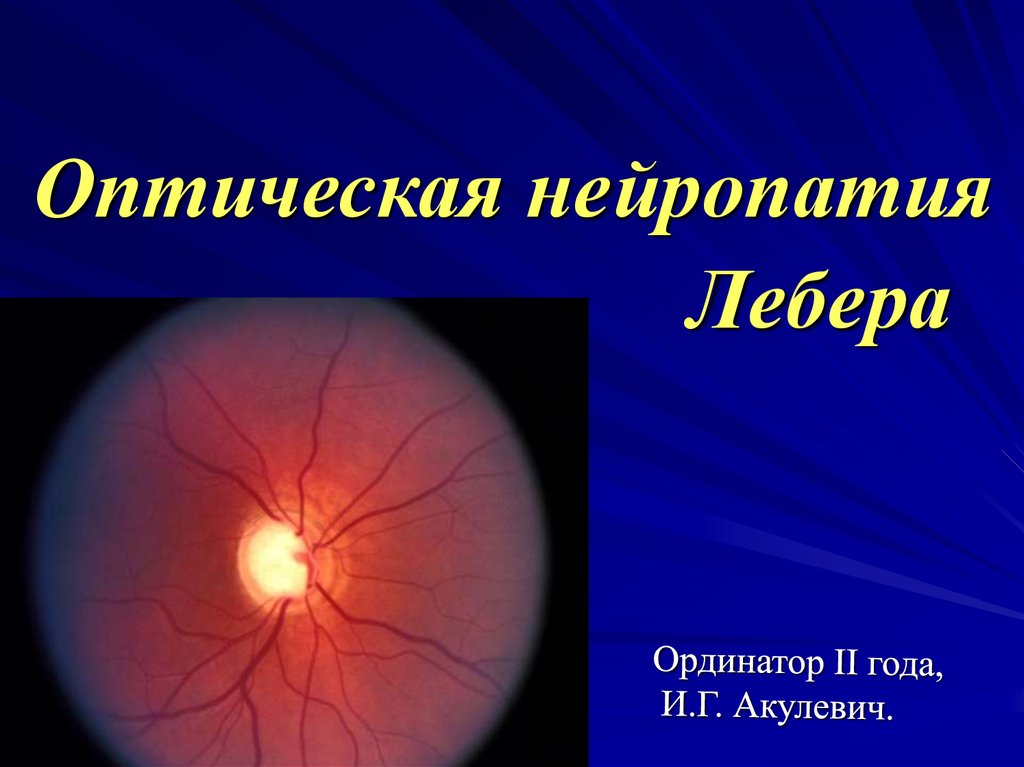 Нейропатия зрительных. Нейрооптикопатия зрительного нерва. Оптическая ишемическая нейропатия ДЗН.