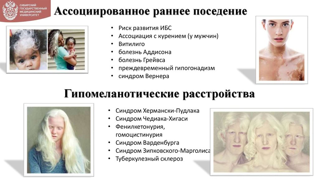 Ассоциированное раннее поседение