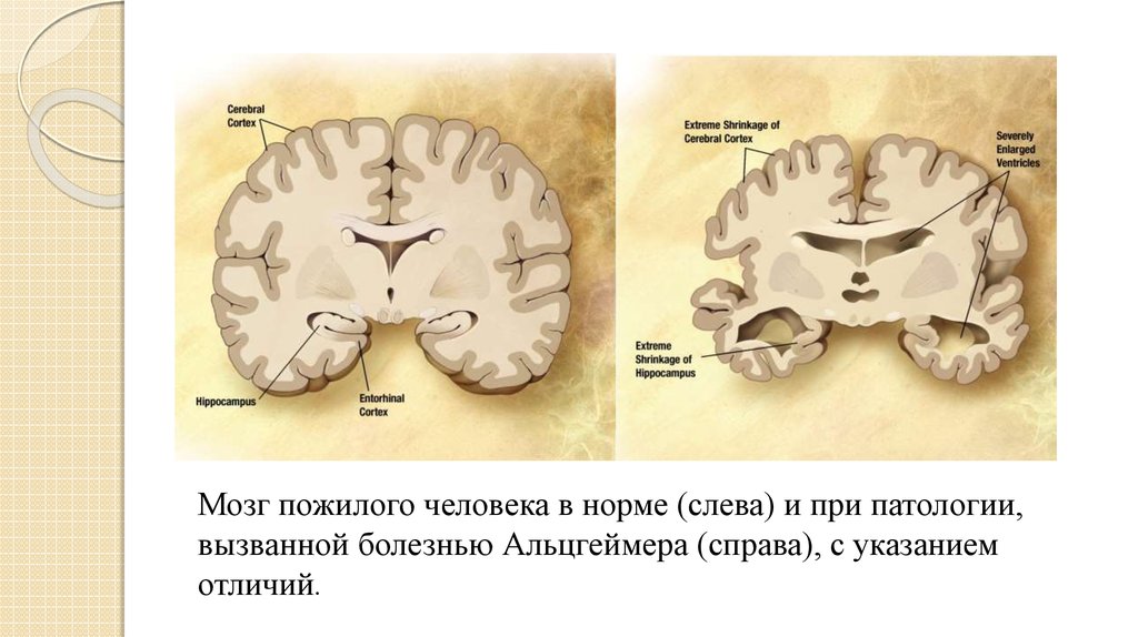 Болезнь альцгеймера проект по биологии