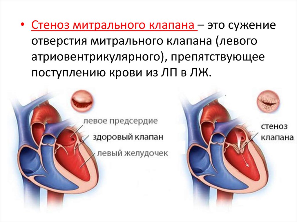 Регургитация митрального клапана 2