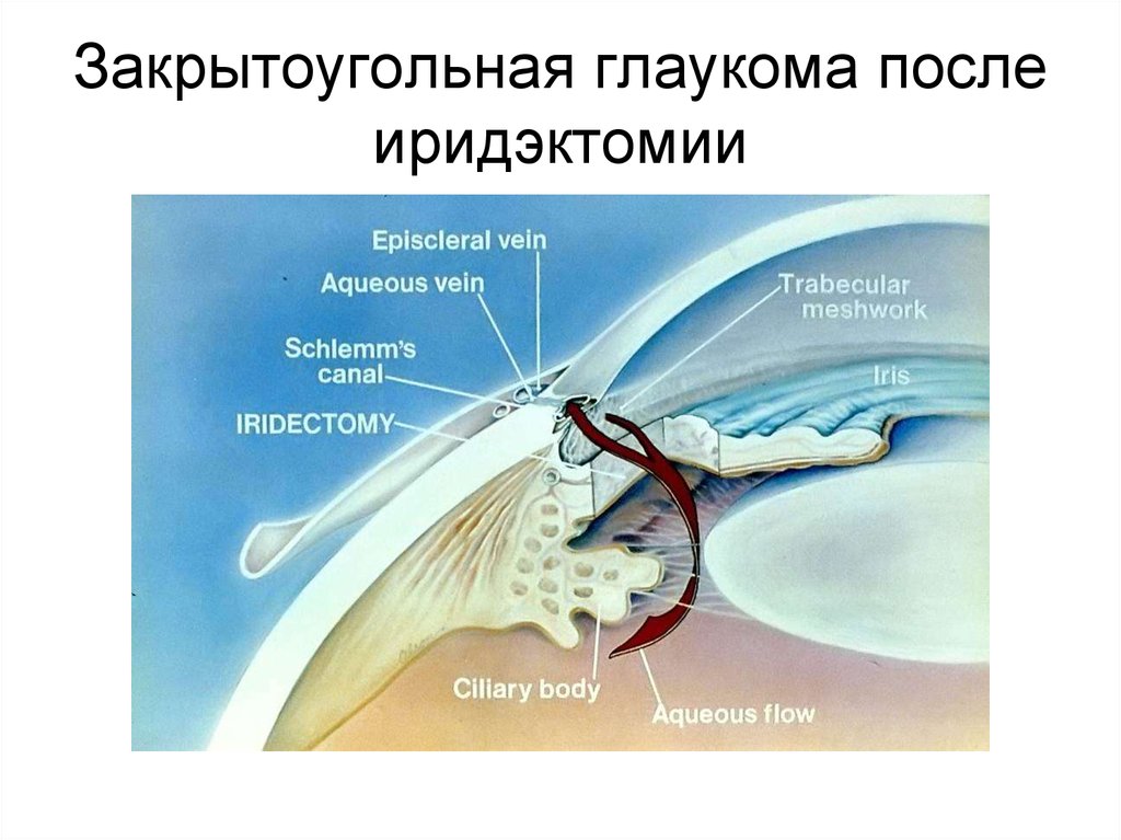 Закрытоугольная глаукома. Закрытоугольная глаукома схема. Закрытоугольная форма глаукомы. Катаракта закрытоугольная и открытоугольная. Закрытоугольная и открытоугольная глаукома отличия.