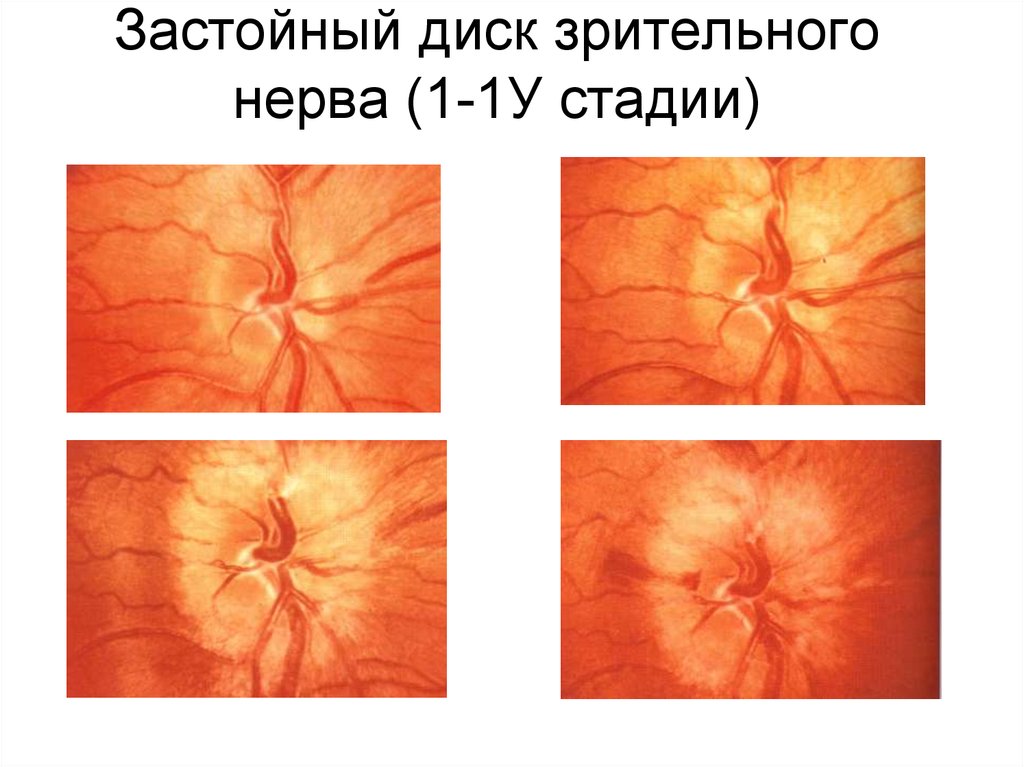Диск глазного нерва. Деколорация диска зрительного нерва. Застойный диск зрительного нерва 1 стадия. Отек диска зрительного нерва офтальмоскопия.
