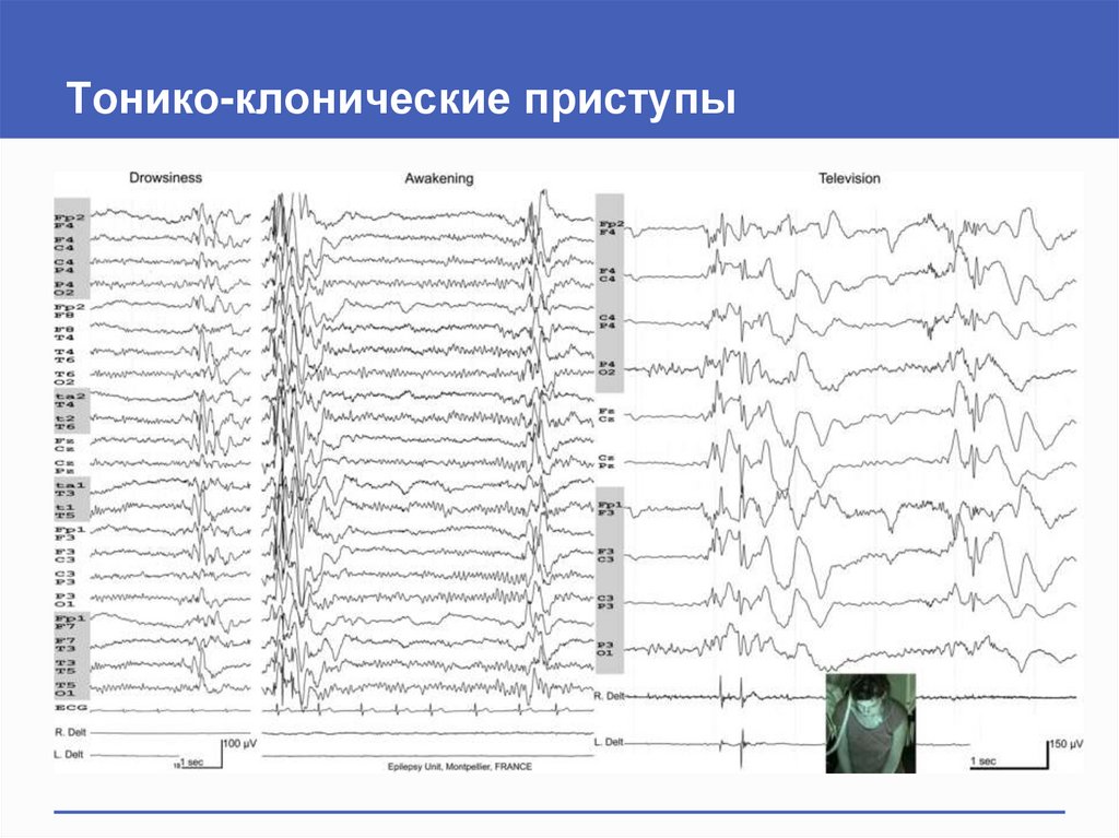 Индекс эпилептиформной активности. Тонико клонические припадки на ЭЭГ. Диффузная эпилептиформная активность. Классификация эпилептиформной активности по Людерсу. Эпилептиформное возбуждение.