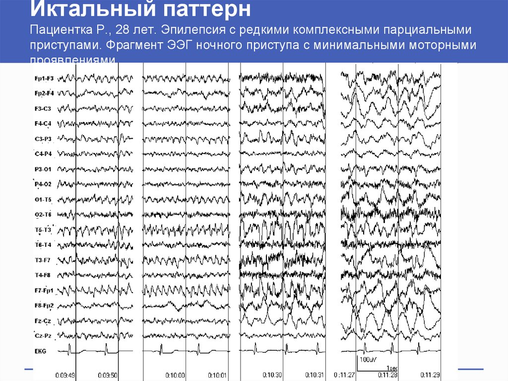 Ээг показывает эпилепсию. ЭЭГ при эпилептическом припадке. Иктальный паттерн на ЭЭГ при эпилепсии. Эпилептиформная активность на ЭЭГ. ЭЭГ при эпилепсии расшифровка.