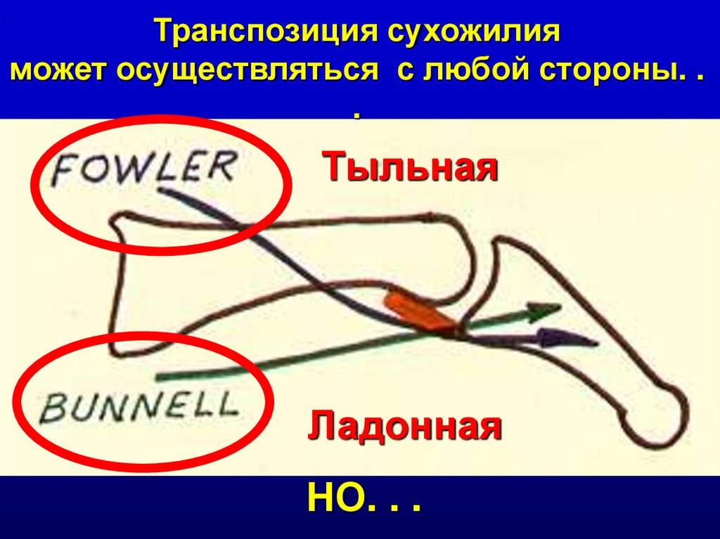 Любой стороны. Транспозиция сухожилий. Операция транспозиция сухожилия. Транспозиция сухожилий стопы. Транспозиция сухожилий кисти.