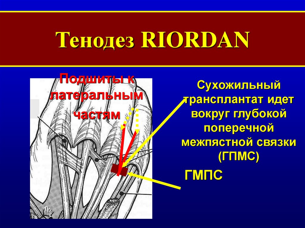 Тенодез сухожилия