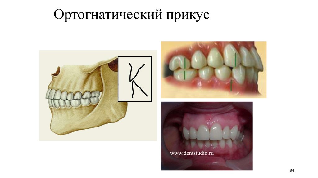 Опистогнатический прикус картинки