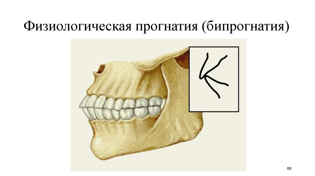 Прогения