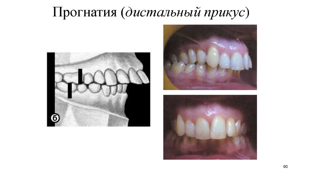 Фото прогения и прогнатия