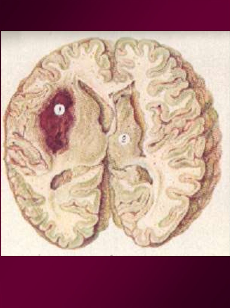Обширный инсульт. Геморрагический инсульт макропрепарат. Ишемический инсульт мозга макропрепарат. Ишемический инсульт патанатомия препараты. Геморрагический инсульт патанатомия.