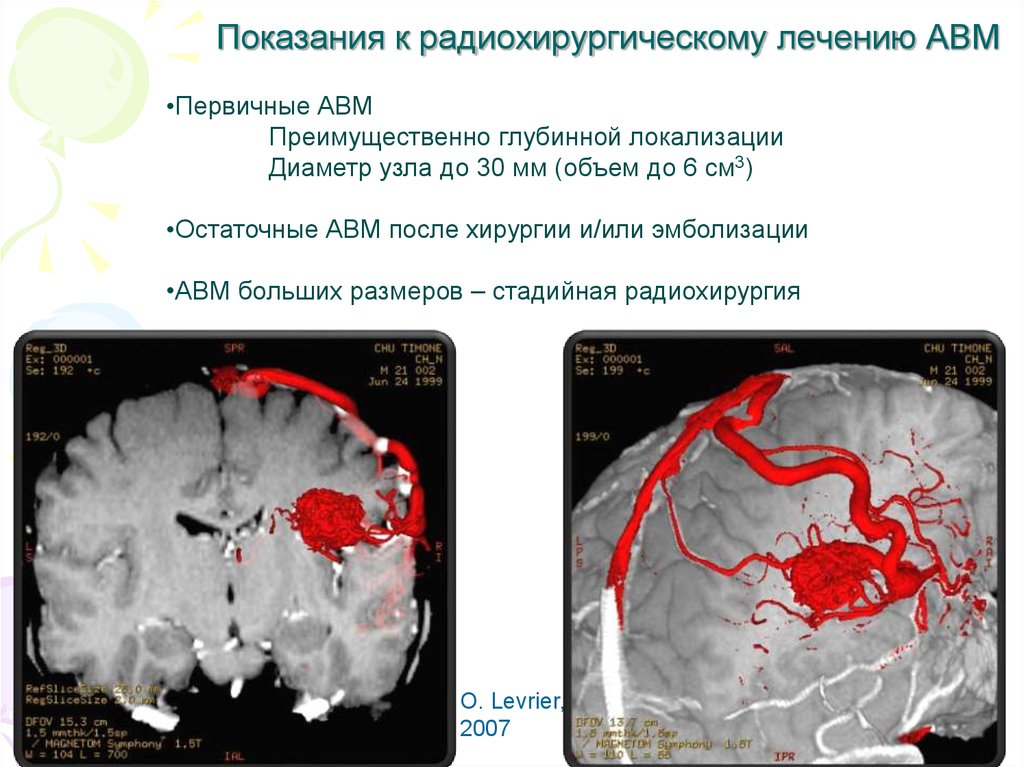 Разрыв показание. Показания к радиохирургии. Разрыв АВМ головного мозга.