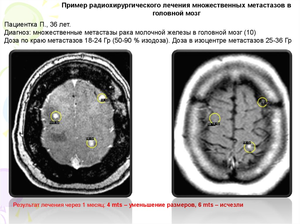 Меланома метастазы в мозг. Множественные метастазы в головной мозг. Метастазы головного мозга кт. Метастазы меланомы в головной мозг мрт. Размер метастаз в головном мозге.
