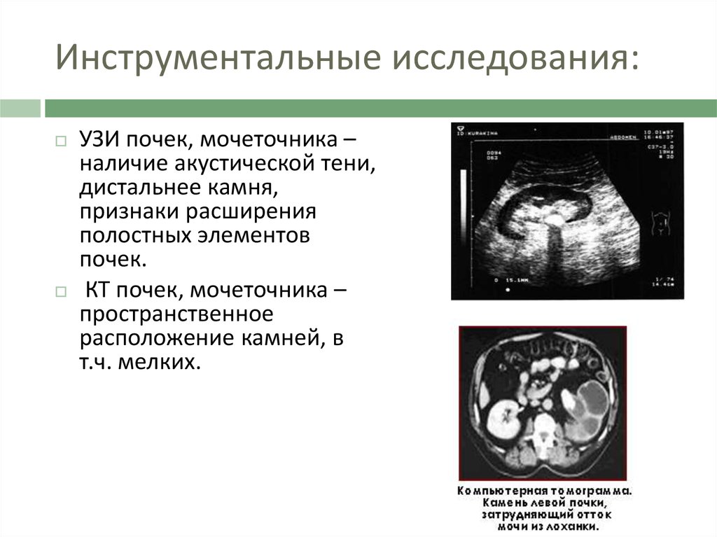 Камни в почках на узи фото