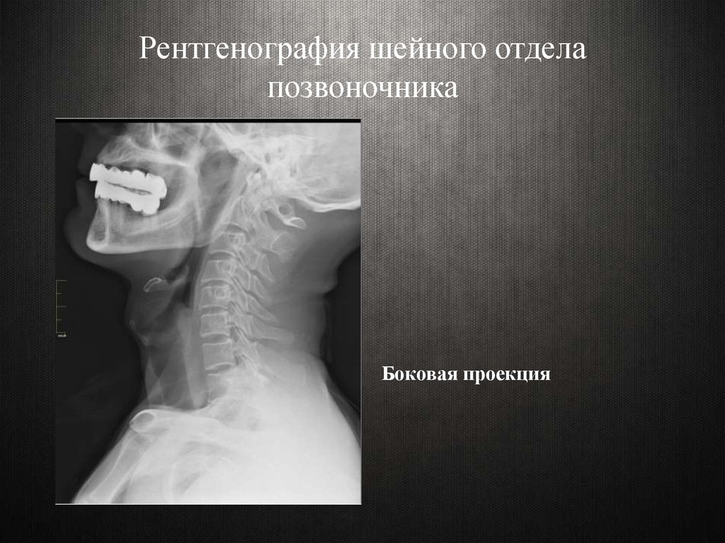 Снимок шейного отдела позвоночника. Шейный отдел позвоночника рентген боковая проекция. Боковая проекция шейного отдела позвоночника норма. Рентген шейного отдела позвоночника сбоку. Рентгенография шейного отдела позвоночника в боковой проекции.