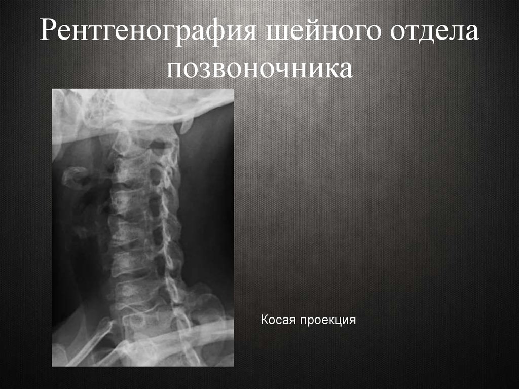 Рентгенография отдела позвоночника. Рентген шейного отдела прямая проекция. Шейный отдел позвоночника рентген норма. Дисторсия шейного отдела позвоночника рентген. Шейный отдел позвоночника рентген анатомия.