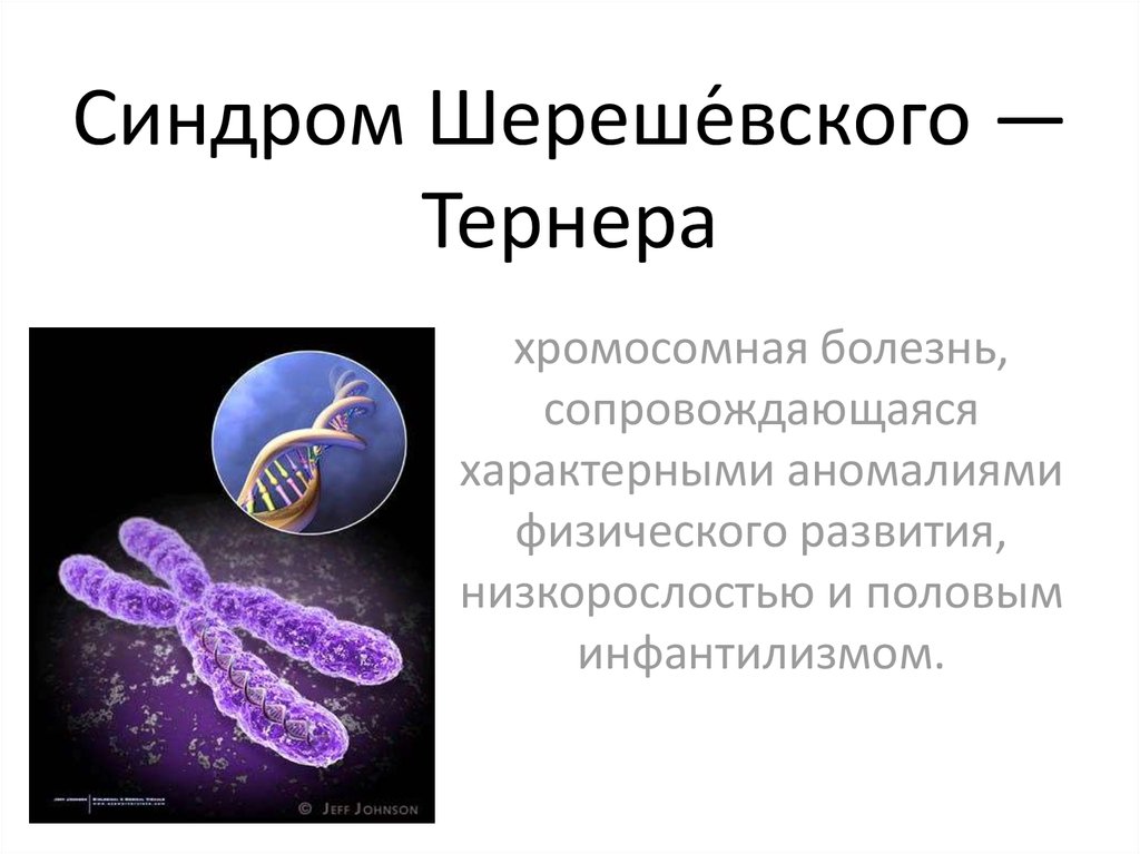 Синдром шерешевского тернера презентация неврология