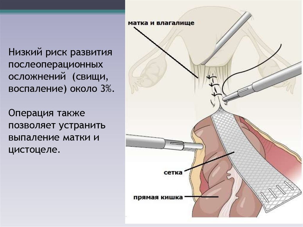 Операция при опущении матки