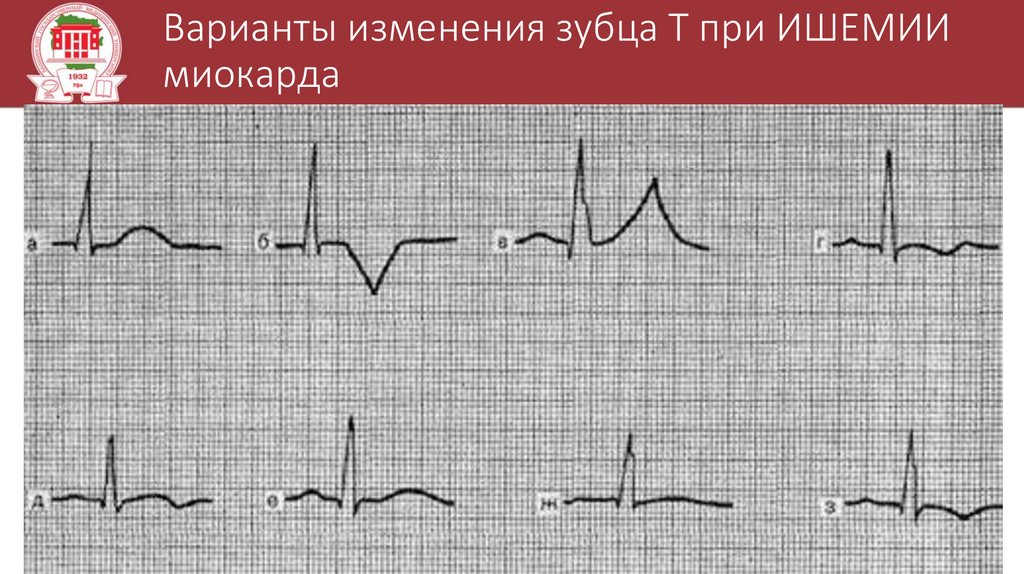 Что значит изменения зубца т. Отрицательный коронарный зубец т на ЭКГ. Зубец т ишемия на ЭКГ. Высокий зубец т на ЭКГ В v2 v3. Коронарный зубец т на ЭКГ.