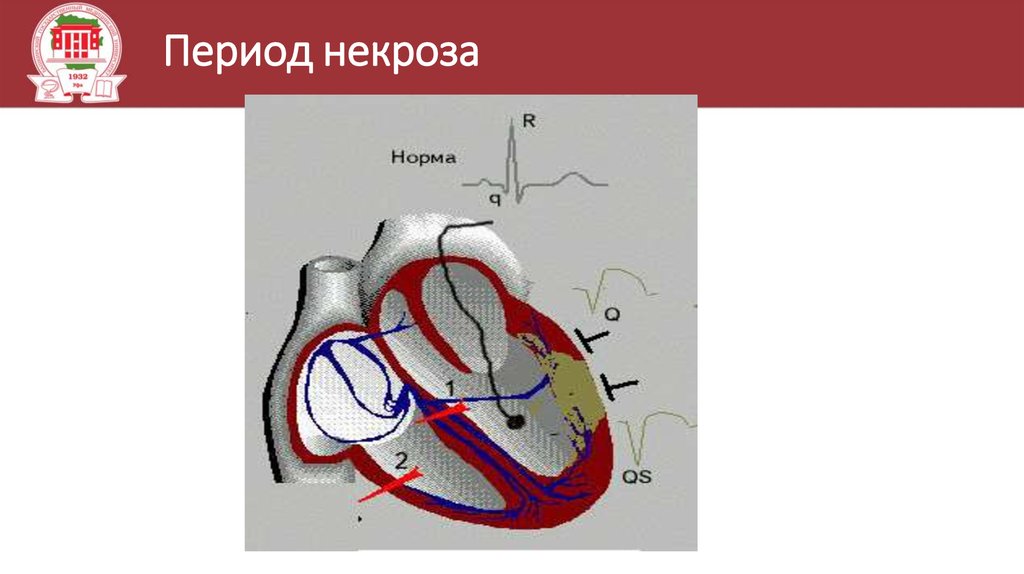 Марс в кардиологии. Интрамуральных ганглиях миокарда. Интрамуральная система сердца. Интрамуральные отделы левого желудочка.