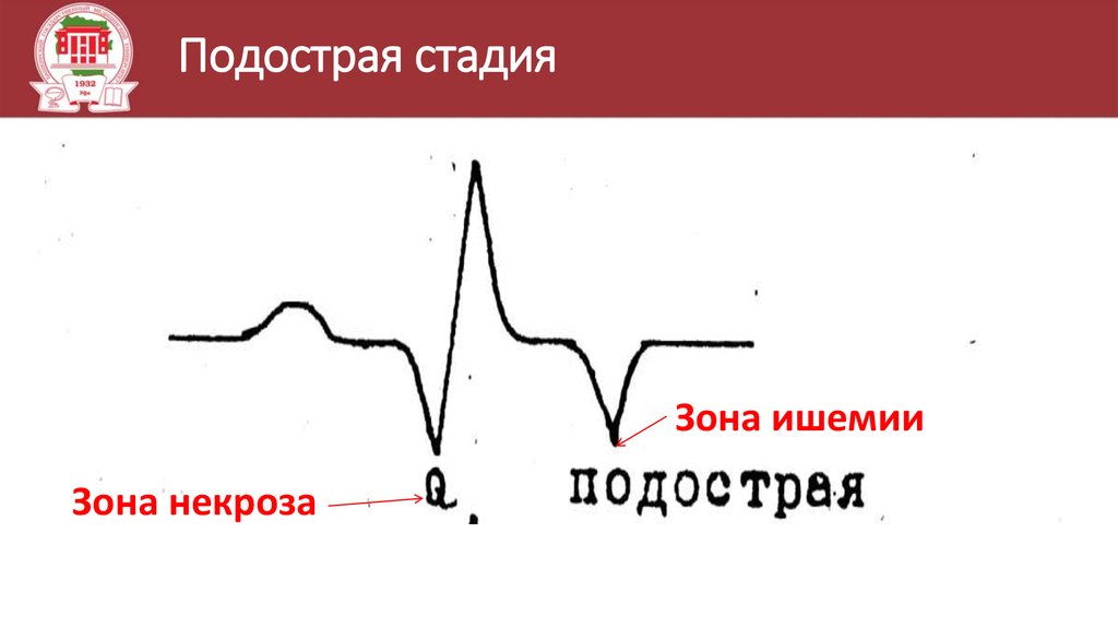 Мурашки экг. Подострая стадия. Подострая стадия ИС. Подострый эудитерованная стадия. Острота подострая и стадия.