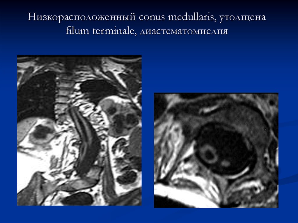Низкорасположенный conus medullaris, утолщена filum terminale, диастематомиелия