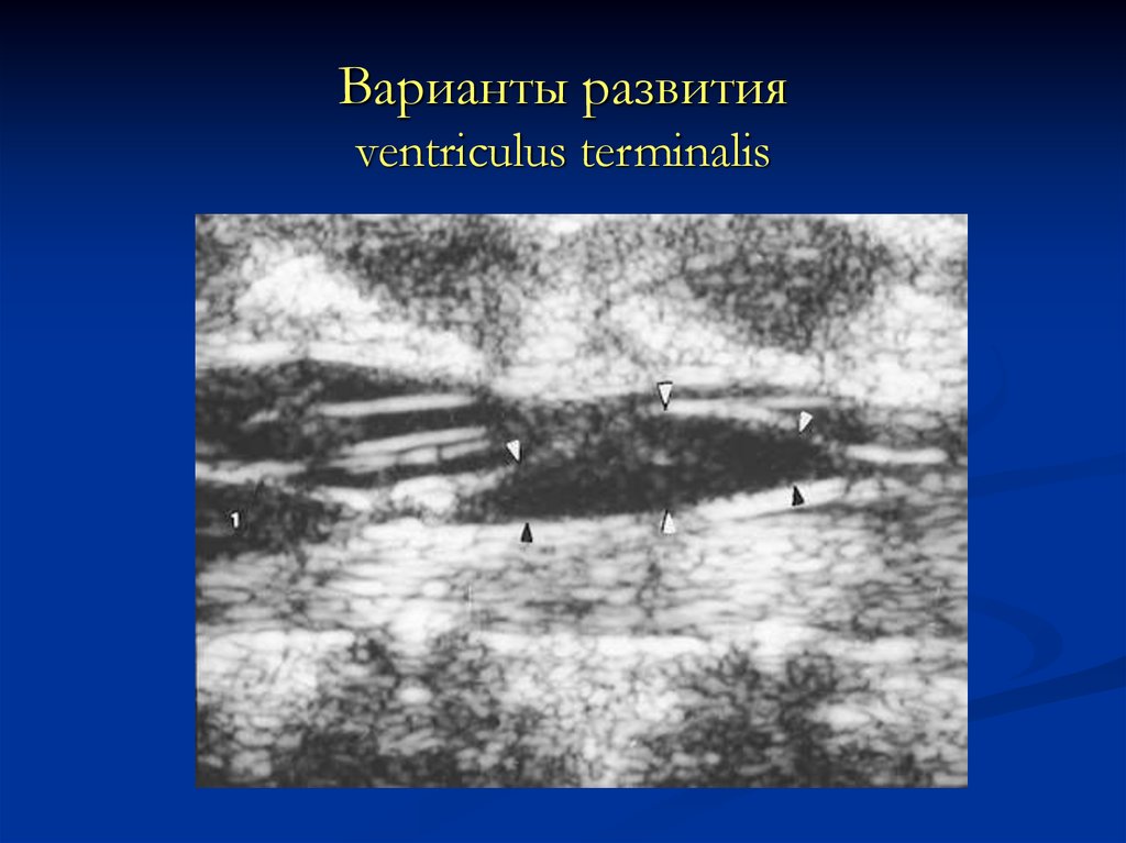 Варианты развития ventriculus terminalis