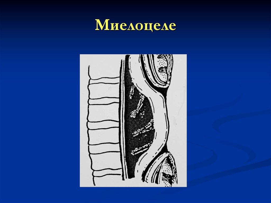Миелоцеле