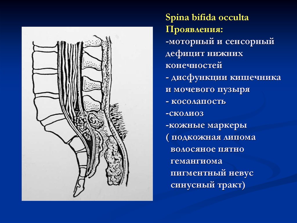 Spina bifida occulta Проявления: -моторный и сенсорный дефицит нижних конечностей - дисфункции кишечника и мочевого пузыря -