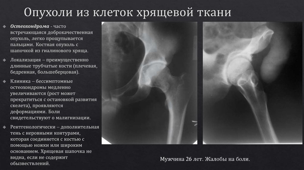 Рентгенологическая картина гигантоклеточной опухоли характеризуется разновидностями