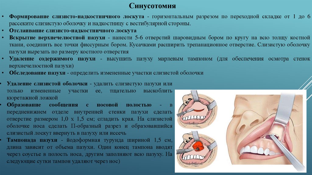 Верхнечелюстной синусит презентация