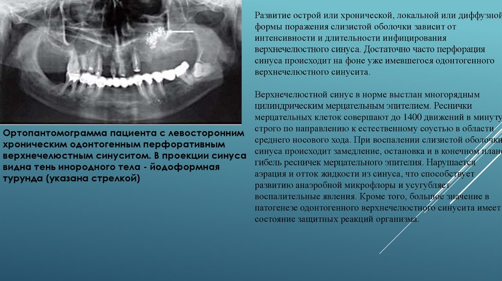 Одонтогенный гайморит лечение