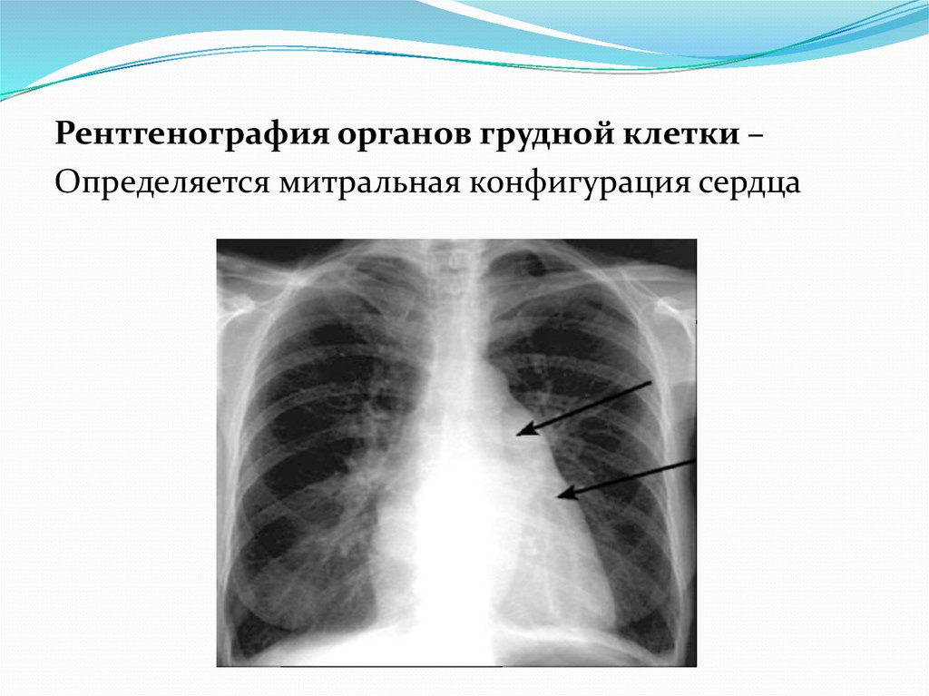 Рентгенография сердца. Рентген сердца при митральной недостаточности. Митральный стеноз рентген. Митральная конфигурация сердца рентген. Рентген грудной митральная конфигурация.