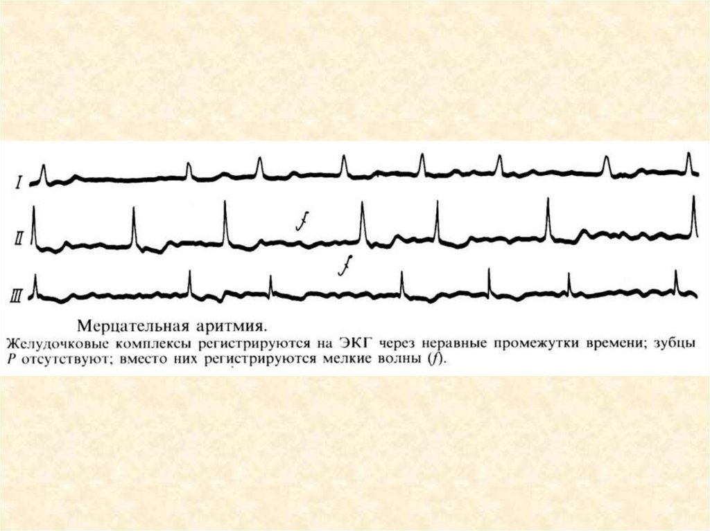 Нарушение ритма сердца карта вызова