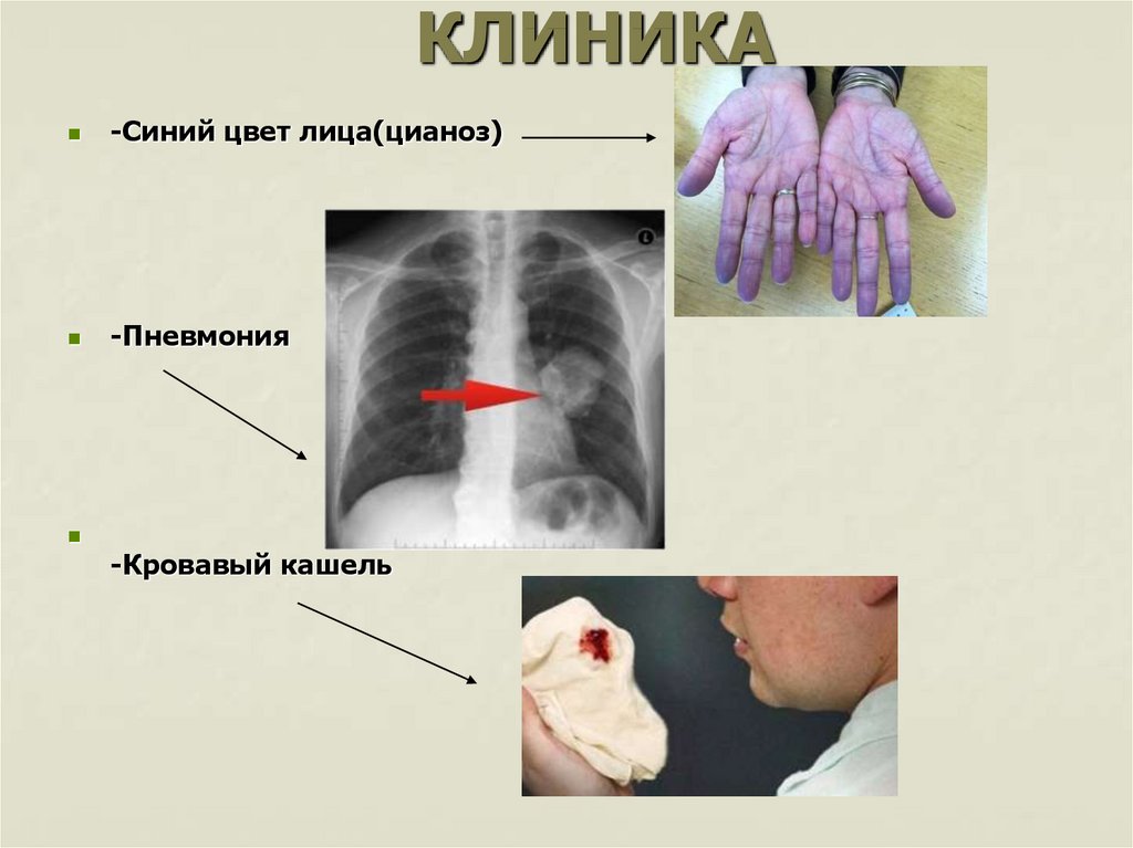 Презентация испанский грипп