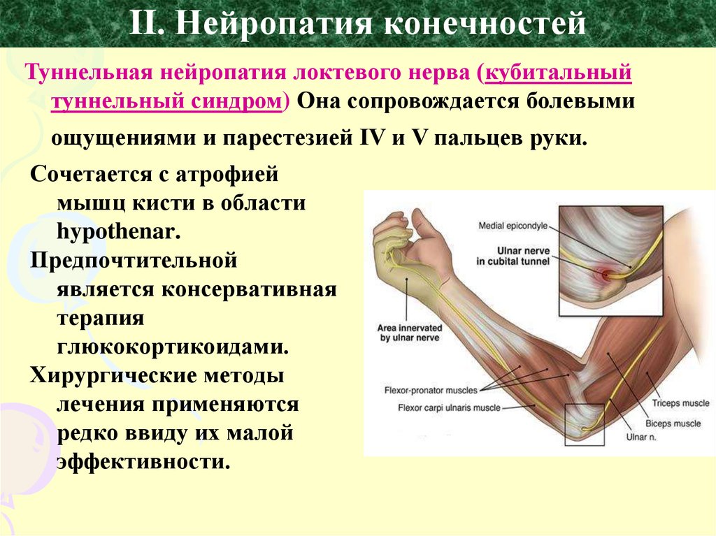 Нейропатии нервов руки. Нейропатия локтевого нерва. Нейропатия локтевого нерва синдром. Полинейропатия лучевого нерва. Синдром поражения локтевого нерва.