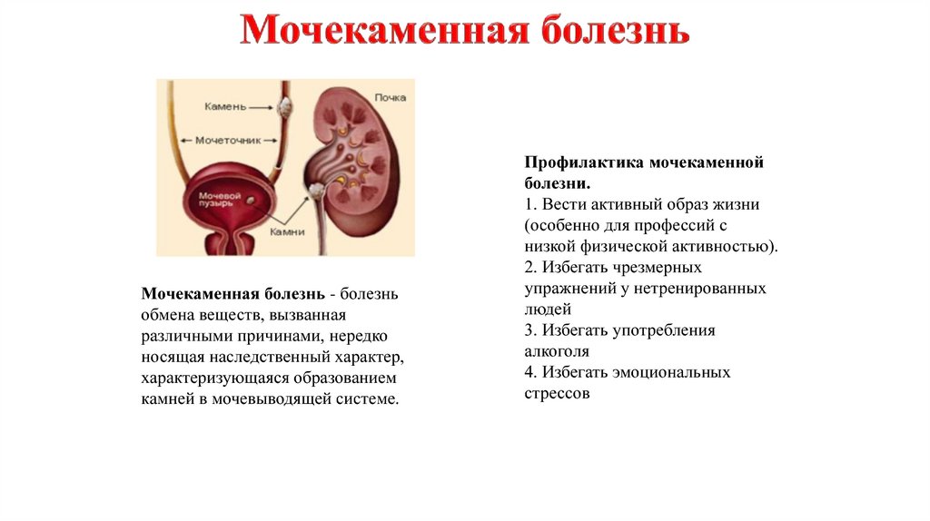 Мочекаменная болезнь у женщин