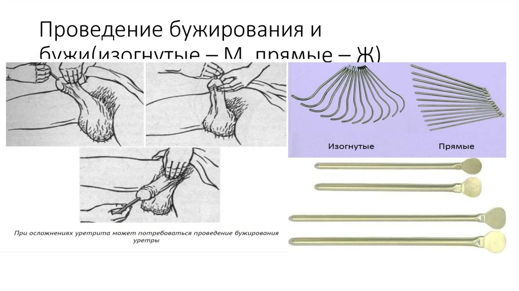 Бужирование прямой кишки