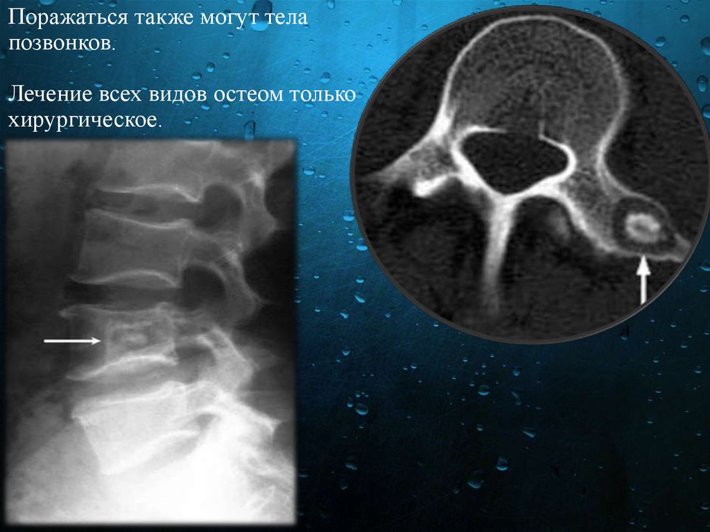 Очаговые изменения костей. Остеоид остеома позвонка кт. Остеосклеротический очаг в теле позвонка кт. Остеоид остеома тела позвонка на кт.
