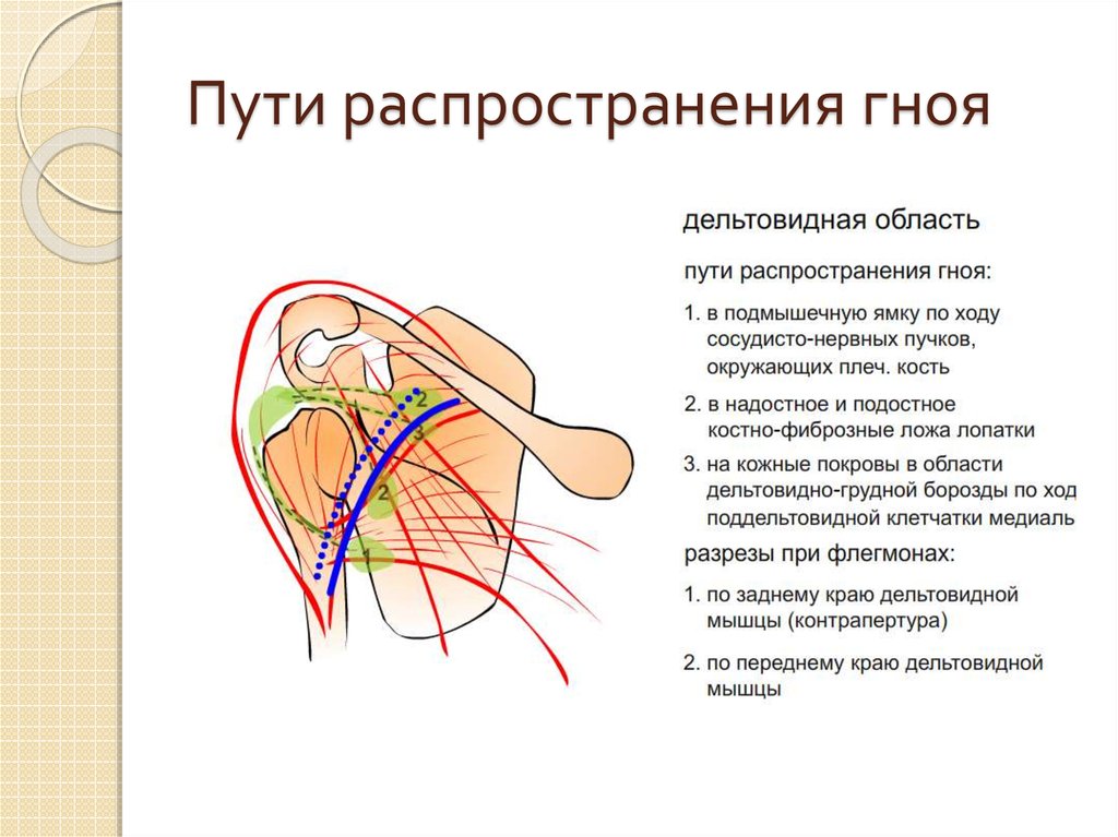 Операции верхних конечностей. Пути распространения инфекции из плечевого сустава. Пути распространения гноя топографическая анатомия. Костно фиброзное ложе лопатки. Пути распространения гноя в подключичной области.