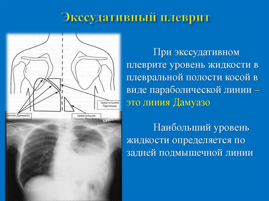 Описание плеврита