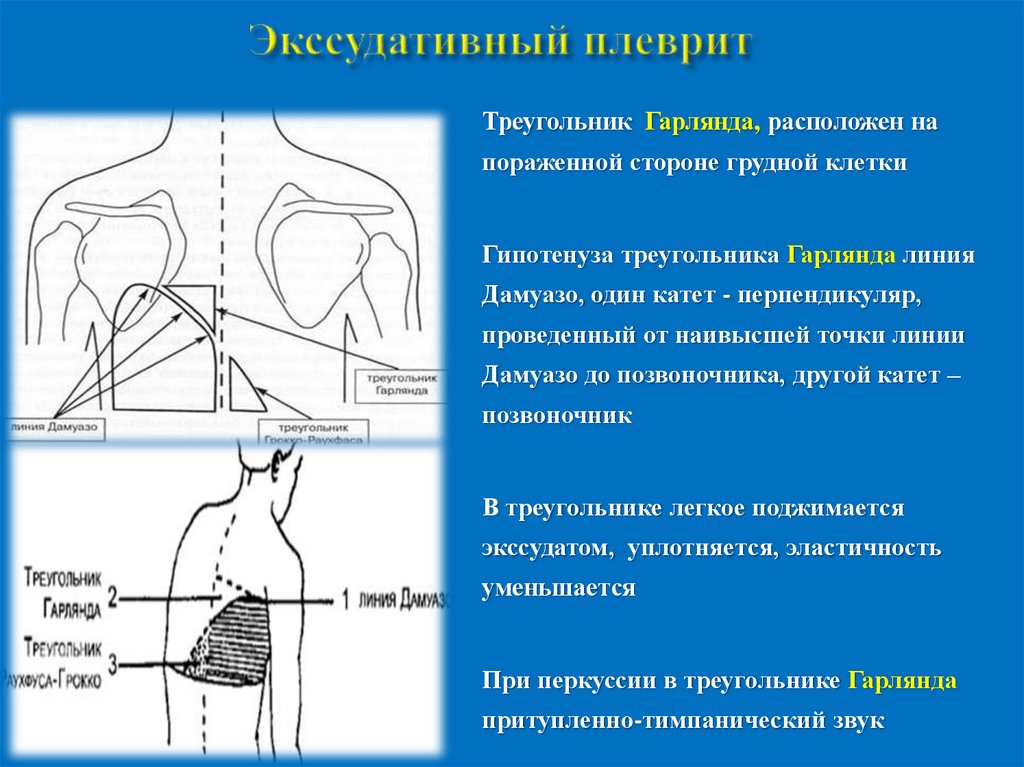 Экссудативный плеврит карта вызова