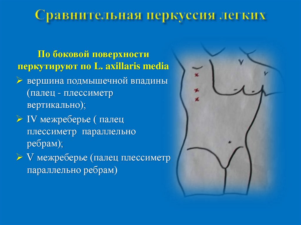 Схема сравнительной перкуссии легких