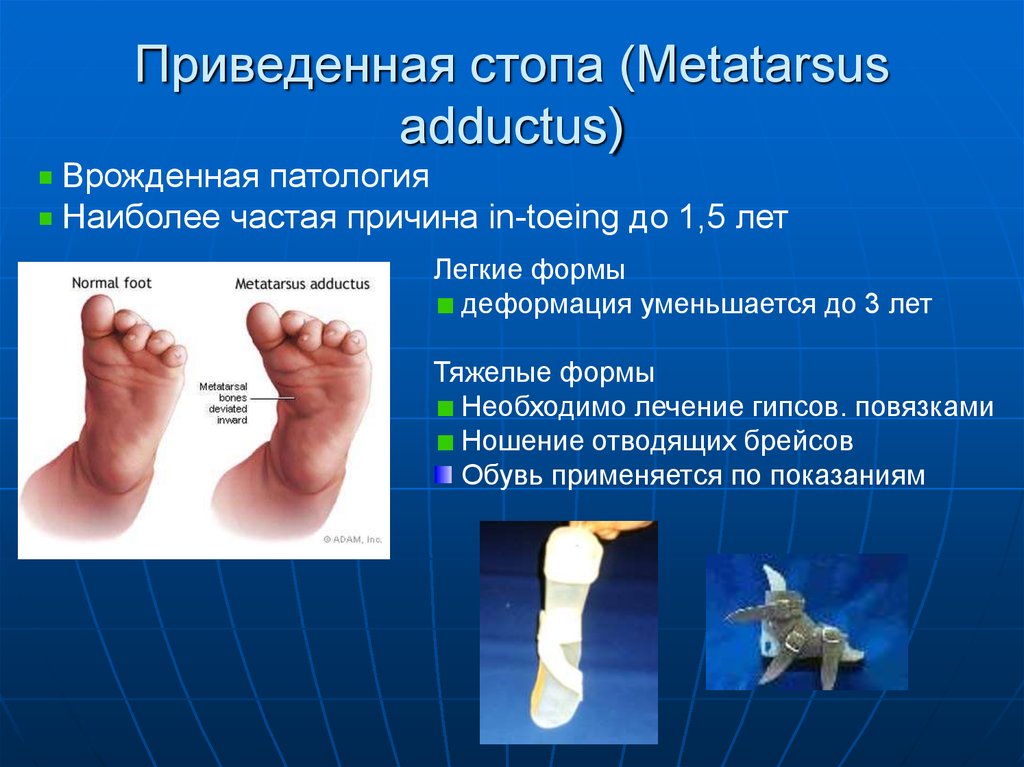 Стопа это простыми словами. Врожденная приведенная стопа. Приведение переднего отдела стопы. Приводящая деформация стопы.