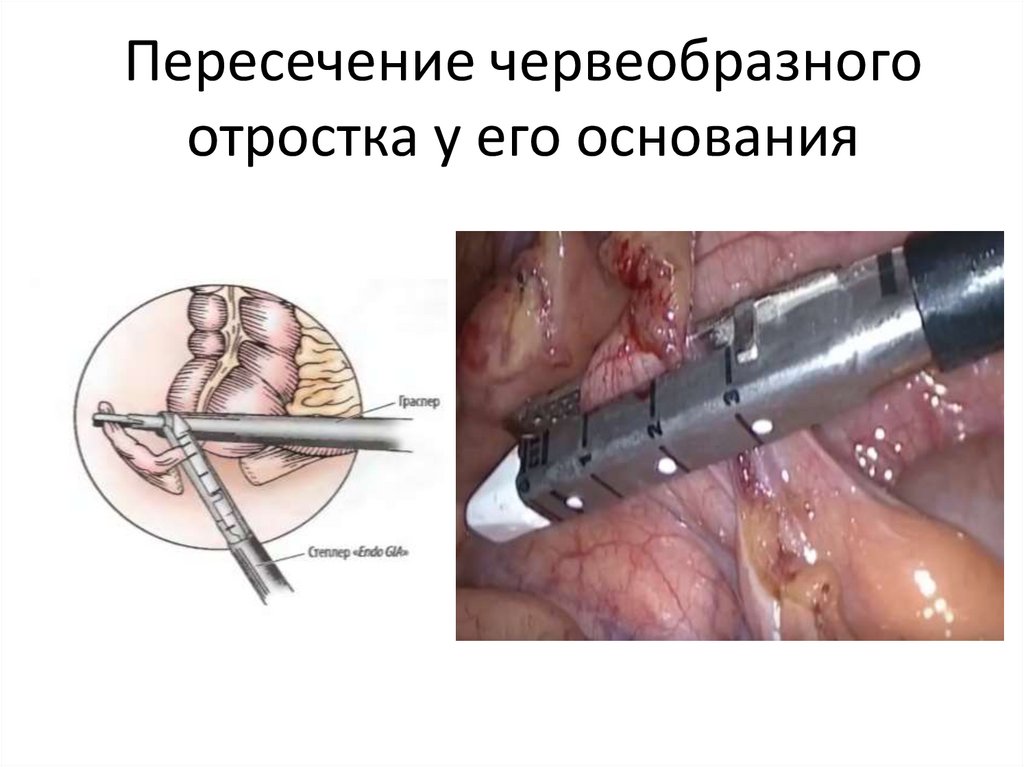 Пересечение червеобразного отростка у его основания